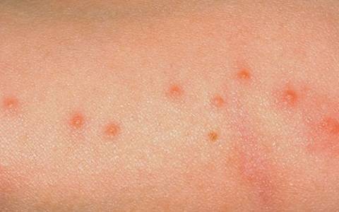 Cysts, Lumps and Bumps: Causes, Symptoms, Treatments