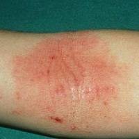Can Allergies Cause Itchy Skin