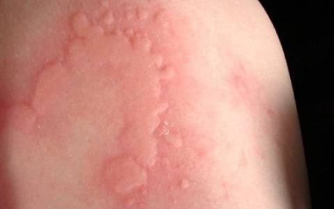Do Allergies Cause Itchy Skin