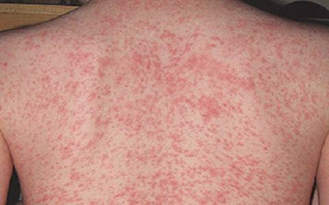 Itchy Skin Caused By Allergies