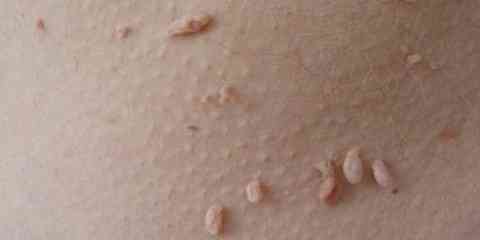 essential oils to remove skin tags