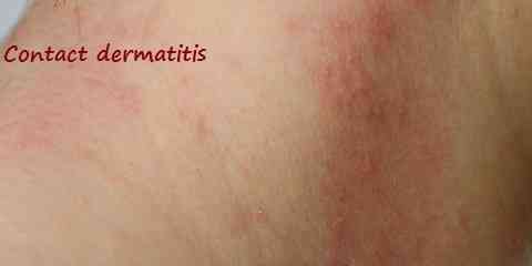 common types of dry itchy fungal allergy skin rashes