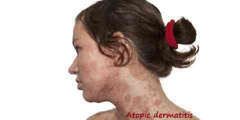 different types of skin rashes and causes on face arms hands babbies children adults toddlers with images pictures
