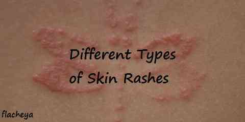 different types of skin rashes