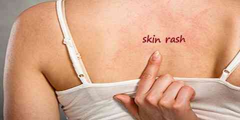 types of skin rashes