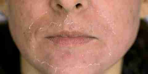 Dry Flaky Skin on Face Nose Around Eyes Legs etc