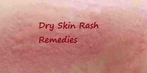 Dry Skin Rash Remedies