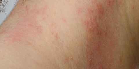 What Causes Skin Allergy Rashes and Itching