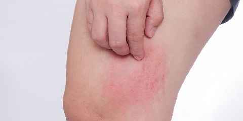 What Disease That Causes Skin Rashes to Appear and Disappear
