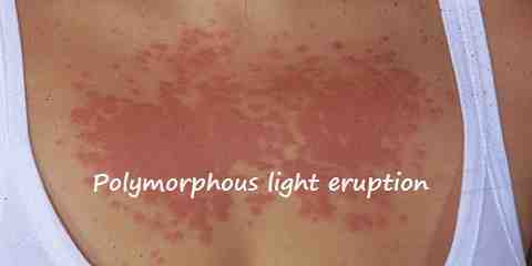 Pictures Images Photos of Skin Rashes Caused By The Sun