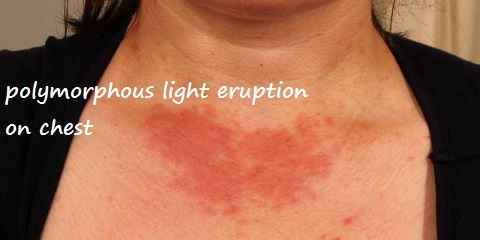 Skin Rashes On Face Chest Arms Hands Neck Legs Fet Caused By The Sun