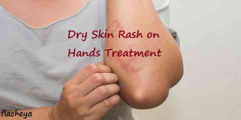 Dry Skin Rash on Hands Treatment
